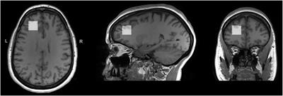 A comparative magnetic resonance spectroscopy study of GABA+ and glutamate referenced to creatine and phosphocreatine in the left dorsolateral prefrontal cortex of perimenopausal women and women of reproductive age